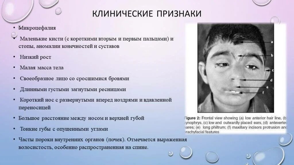 Олигофрения фото взрослых мужчин симптомы Как выявить психические расстройства у детей и подростков sortmozg Дзен