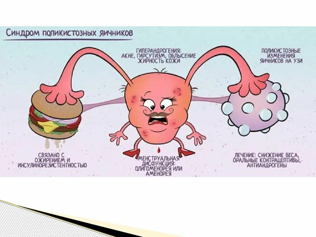 Синдром поликистозных яичников. Синдром поликистоз яичников. Синдром поликистозных яичников причины. Болят яичники стимуляция