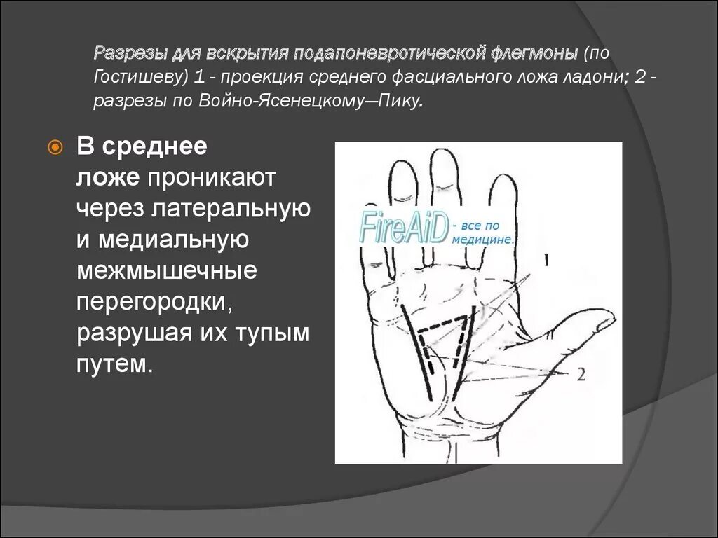 Линии разрезов при вскрытии флегмон предплечья. Флегмона срединного ложа кисти. флегмоны срединного ложа кисти разрезы. разрез по войно-ясенецкому. разрез по войно-ясенецкому на кисти.