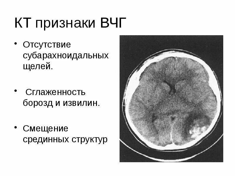 Синдром внутричерепной гипертензии. Диабетическая энцефалопатия патогенез. Клинические и параклинические признаки внутричерепной гипертензии. Признаки вчг что это. Признаки вчг что это.