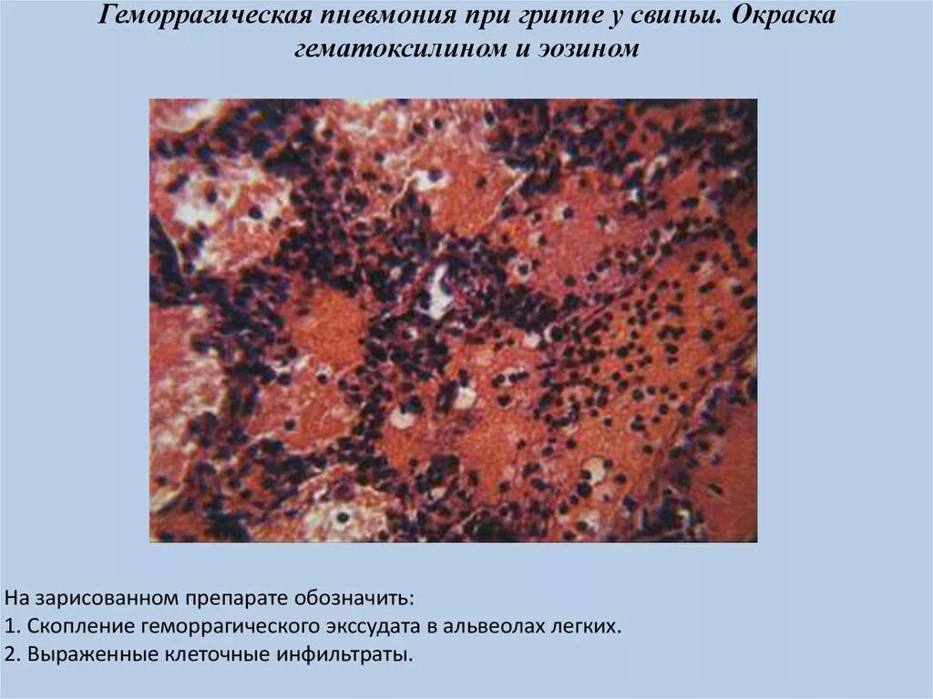 Геморрагическая пневмония микропрепарат патанатомия. Геморрагическая пневмония патанатомия макропрепарат. Серозно геморрагическая пневмония. Серозная пневмония макропрепарат.