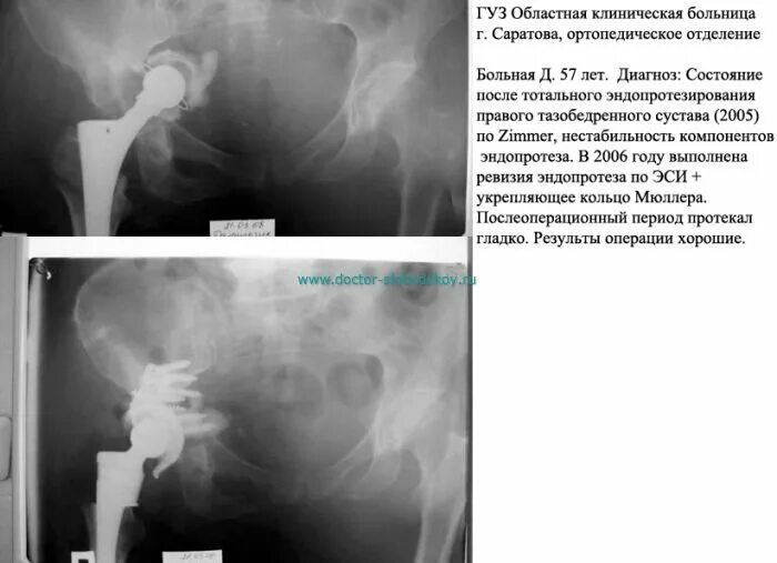 Нестабильность эндопротеза тазобедренного сустава кт. Ревизия тазобедренного эндопротеза. Укрепляющее кольцо эндопротез тазобедренного сустава. Ревизионное эндопротезирование сустава. Эндопротезирование тазобедренного отзывы пациентов