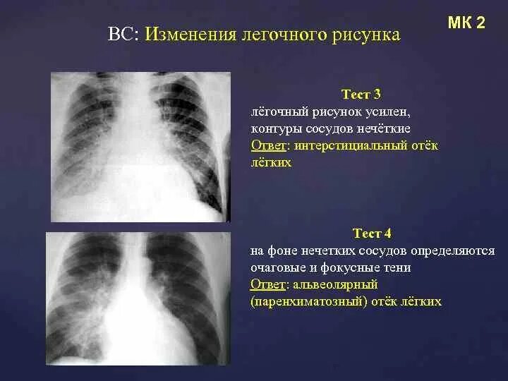 Усилен рисунок. Изменение легочного рисунка. Легочный рисунок усилен. Изменение легочного рисунка на рентгенограмме.