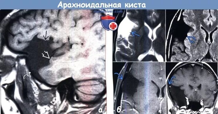 Височная киста головного мозга. Арахноидальная ликворная киста мрт. Арахноидальная киста задней черепной ямки кт. Арахноидальная киста головного мозга мрт. Ретроцеребеллярная арахноидальная киста кт.