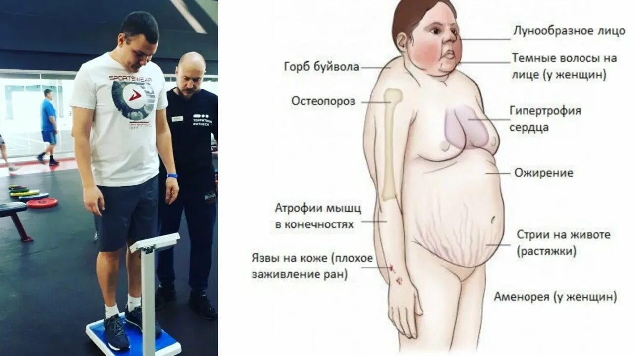 Кортизоловое лицо. Кортизоловое лицо