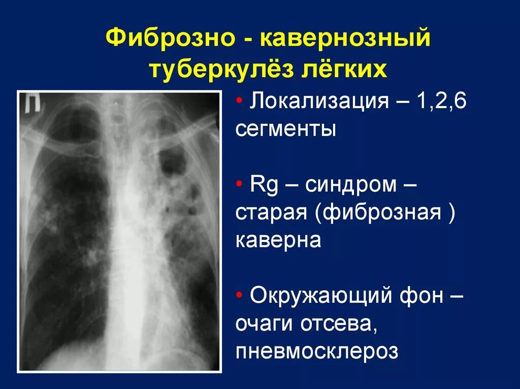 Старый туберкулез. Фиброзно-кавернозный туберкулез рентген. Фибринозно-кавернозный туберкулёз рентген. Каверна при туберкулезе на рентгене. Кавернозная форма туберкулеза легких рентген.