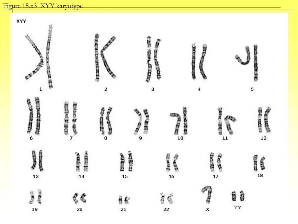 Кариотип гермафродита. 47 XYY кариотип. Синдром Джейкобс кариотип. Кариотип 47 хуу синдром. Удвоение набора хромосом