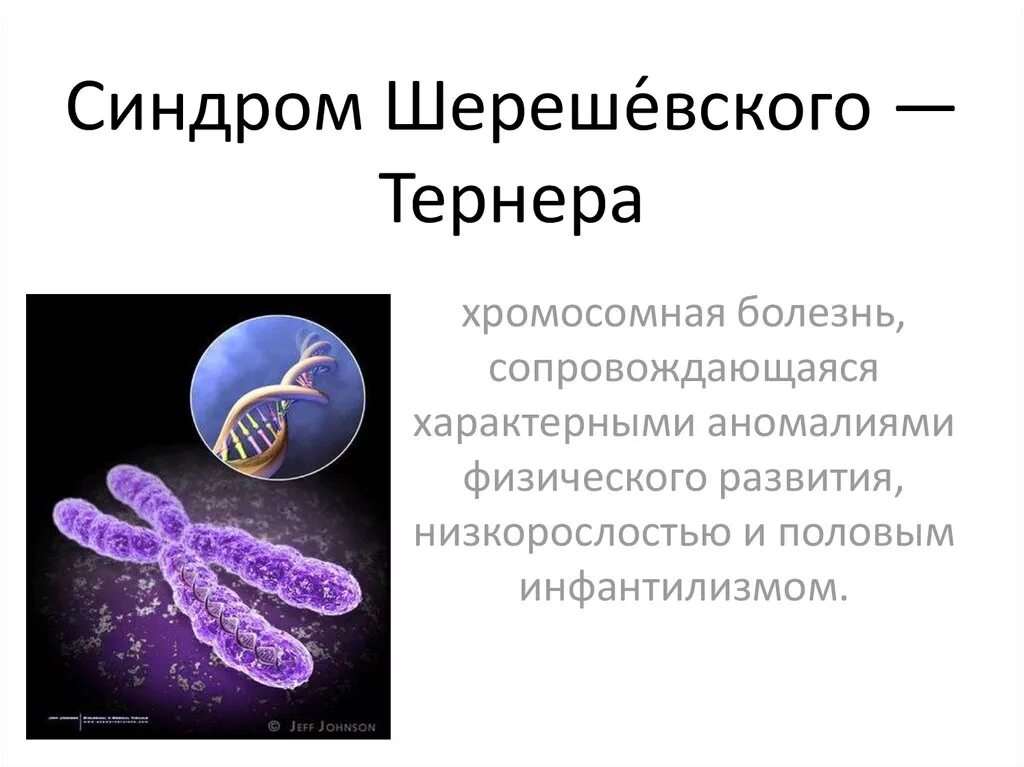 Синдром шерешевского тернера частота. Синдром шерешевского тернера клинические проявления. Синдром шеревского тёрнера. 45 хромосом синдром тернера. Лечение синдрома шерешевского.