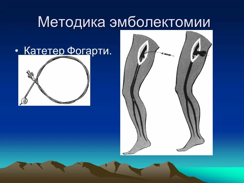 Катетер фогарти. Баллонный катетер Фогарти. Балло нный катетер фогарии. Катетер баллонный для тромбэктомии. Баллонный зонд Фогарти.