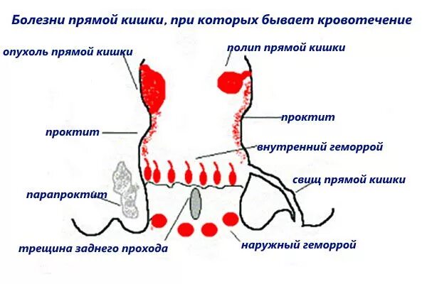 Ректальные железы. Кровотечение из прямой кишки. Кровотечение из заднего прохода.