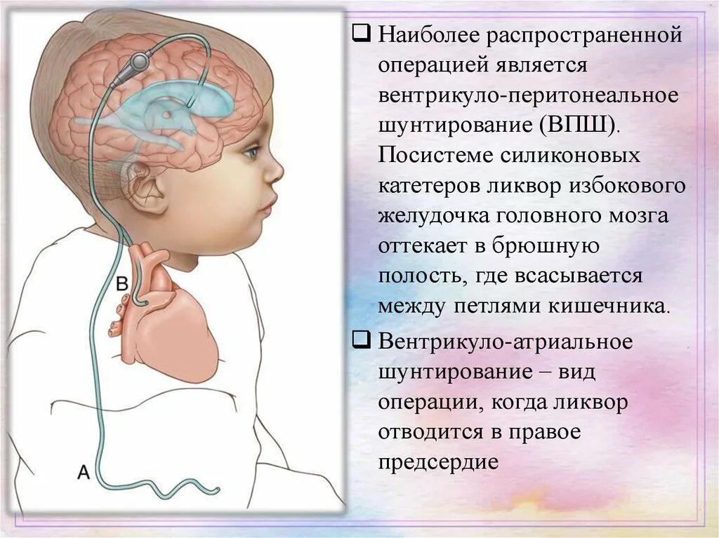 Как выглядит шунт. Вентрикулоперитонеальный шунт схема. Шунт головного мозга при гидроцефалии. Шунт ВПШ вентрикуло-перитонеальный. Вентрикулярный шунт при гидроцефалии.