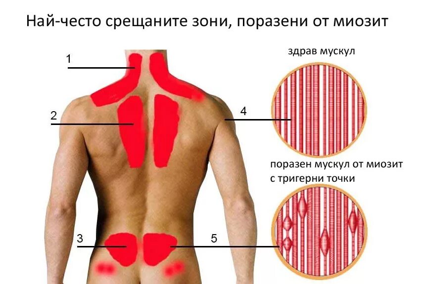 При вдохе отдает в левую. Воспаление мышц поясницы.