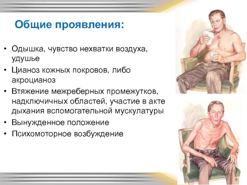 От чего бывает нехватка воздуха. Вынужденное положение при ортопноэ. одышка чувство нехватки воздуха. положение больного при одышке.