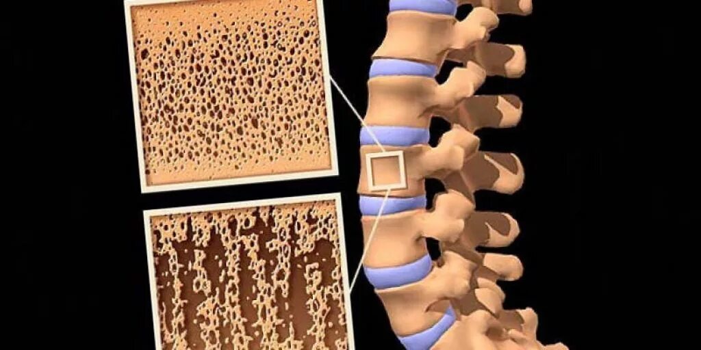 Остеопороз и остеомаляция. Кость без фона. Остеопороз кости. Состояние кости. Состояние кости.