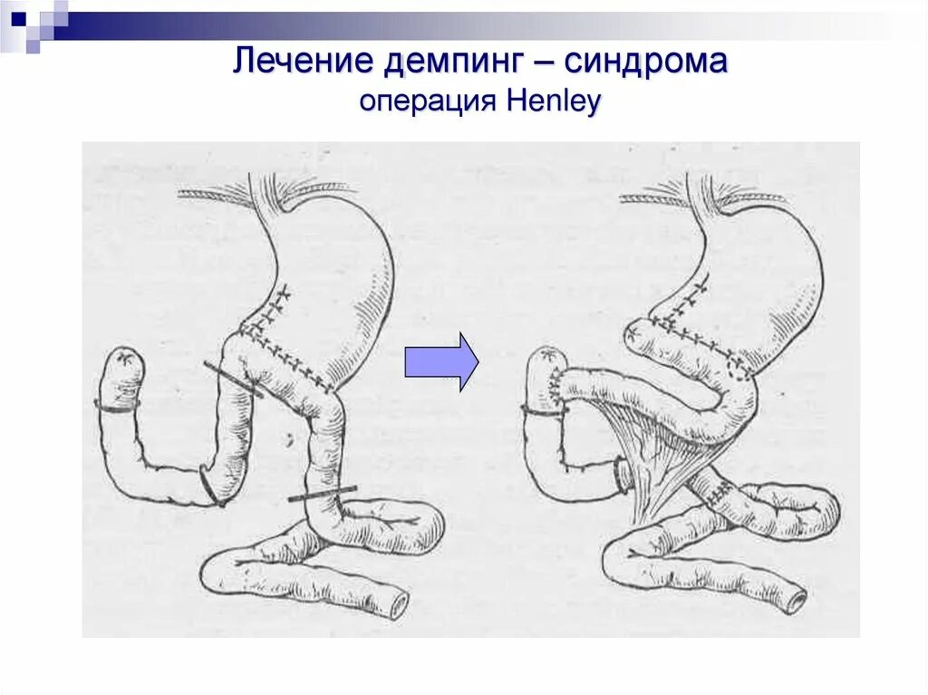 Операция синдром. Реконструктивные операции при демпинг-синдроме. редуоденизация при демпинг синдроме. демпинг синдром лечение хирургическое. болезни оперированного желудка демпинг синдром.