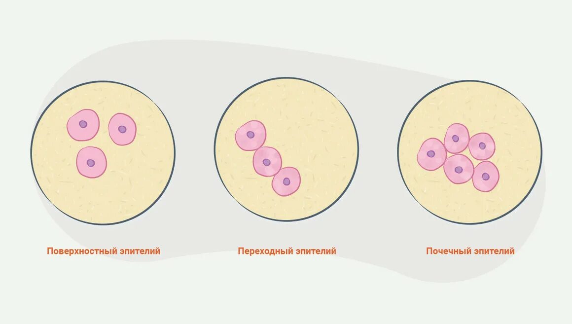 Эпителий мочевых путей норма. Эпителиальные клетки почек цитология. Микроскопия мочевого осадка. Эпителий повышен. Клетки почечного эпителия в моче причины.
