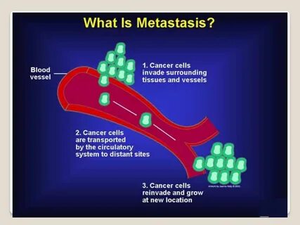 Metastasis