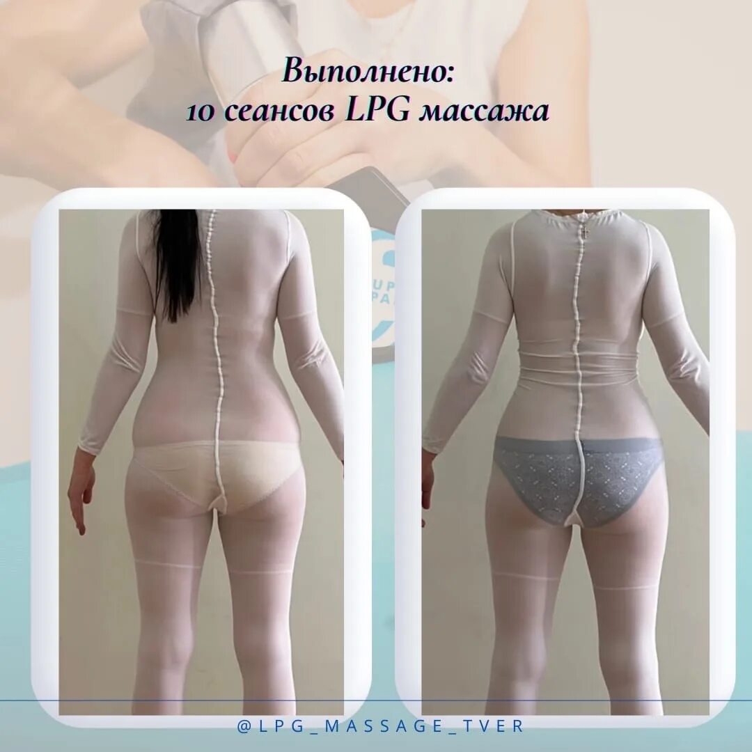 Lpg массаж реклама. Lpg массаж живота. Лпж массаж до и после. Лимфодренажный массаж тела аппаратный. Вакуумный массаж лпж.