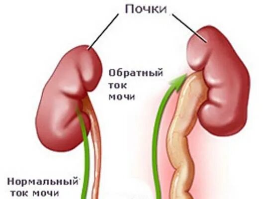 Рефлюкс мочи. Пузырно-мочеточниковый рефлюкс (ПМР). Пузырно почечный рефлюкс. Пузырно-мочеточниковый рефлюкс пассивный. Рефлюкс мочеточников 3.