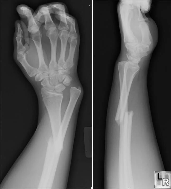 Перелом Галеацци рентген. Перелом со смещением отломков рентген. Перелом лучевой кости со смещением рентгенограмма. Рентген перелома кости предплечья.