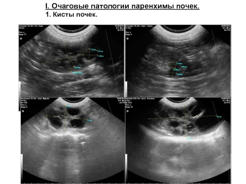 Паренхима почки что это. Киста паренхимы правой почки что это такое. Кистозные образования паренхимы почек. Кисты паренхимы обеих почек.