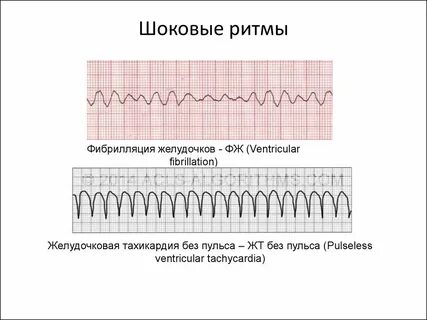 Фибрилляция ритм