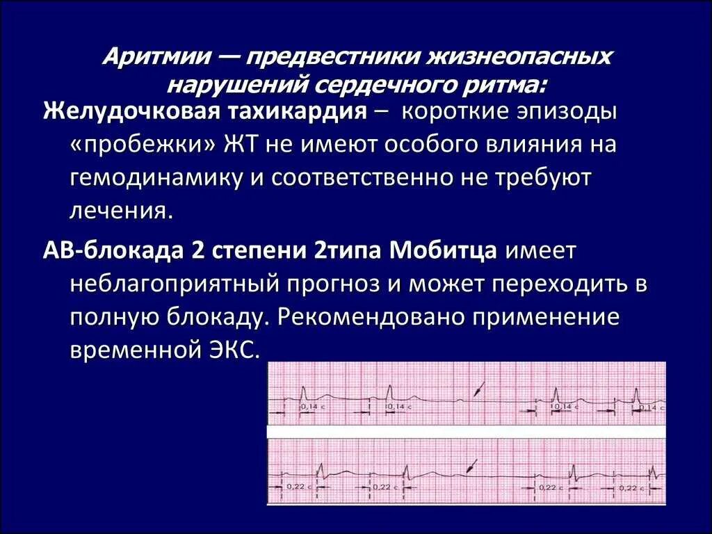 Срывается ритм. Нарушение ритма. нарушения сердечного ртм. нарушение сердечного ритма, аритмию. заболевания нарушения ритма.
