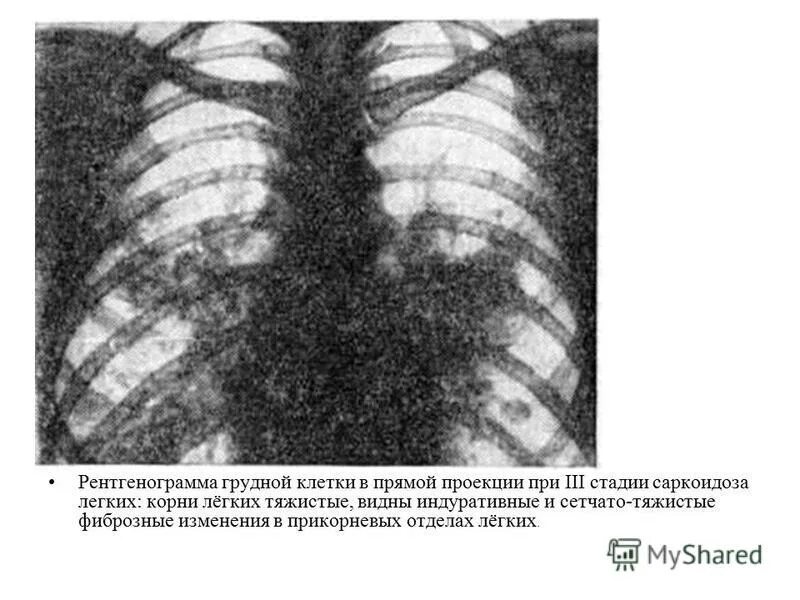 Саркоидоз рентген грудной клетки. Тяжистые корни рентген. Тяжистые корни легких что это на рентгене. Флюорография корни тяжистые. Корень легкого уплотнен что значит