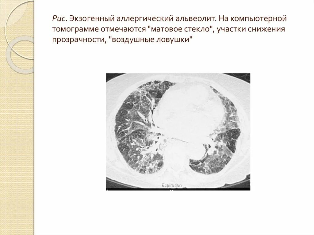 Альвеолиты рекомендации. Экзогенный альвеолит легких кт. Аллергический альвеолит кт картина. Экзогенный аллергический альвеолит кт. Гиперчувствительный альвеолит кт.