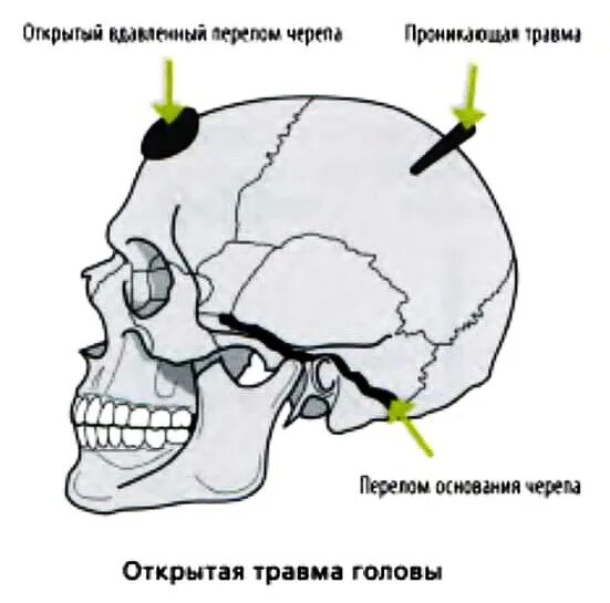 Череп разрыв. Перелом головного черепа. Открытые повреждения черепа и головного мозга. Вдавленный перелом черепа.