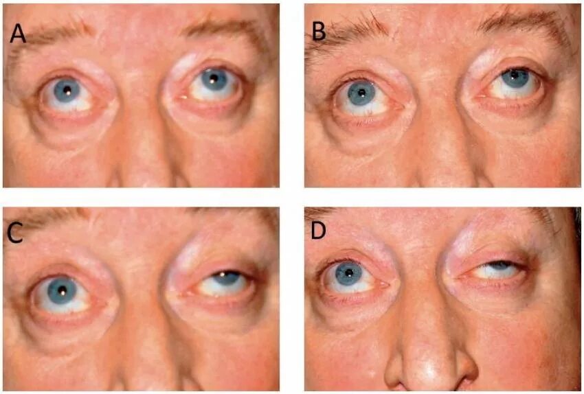 Слабость глаз. Myasthenia Gravis. Заболевание миастения Гравис. Офтальмоплегическая миопатия.