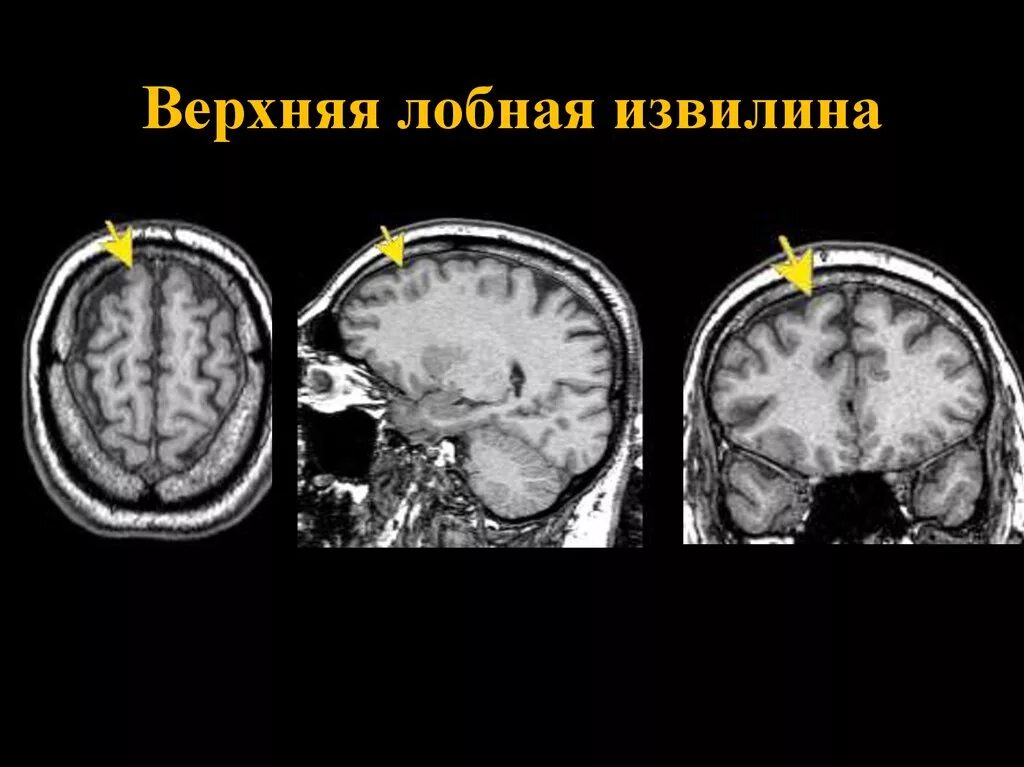 Сильвиева борозда анатомия. Мозговая организация речи. Поражение задней трети верхней височной извилины. Нижняя височная извилина. Задний отдел лобной доли.