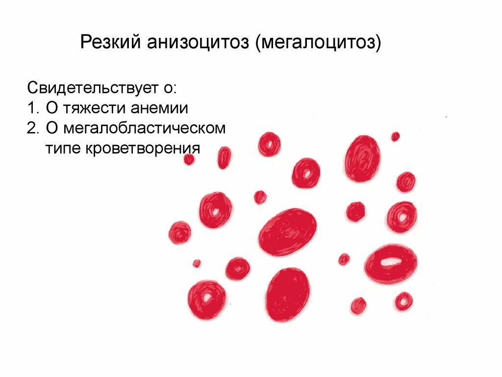 Пониженные макроциты. Анизоцитоз. Анизоцитоз лейкоцитов. Анизоцитоз и пойкилоцитоз. Анизоцитоз эритроцитов.