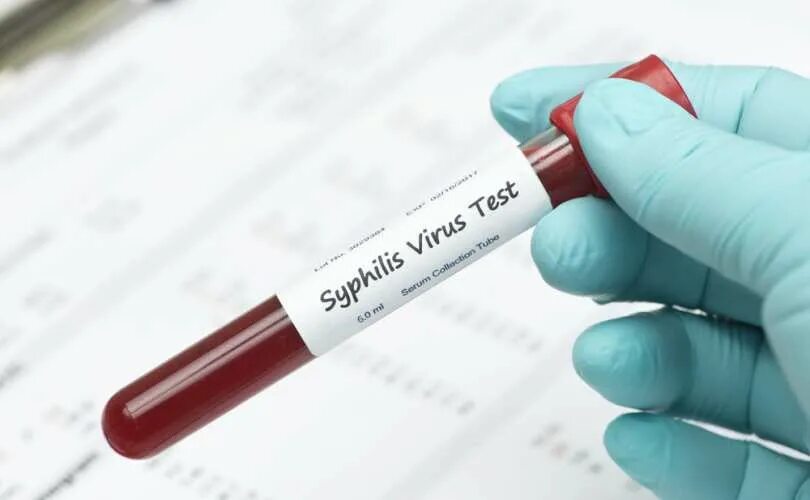 Исследование крови на сифилис. Исследование крови на реакцию Вассермана. Пробирка для крови на сифилис.