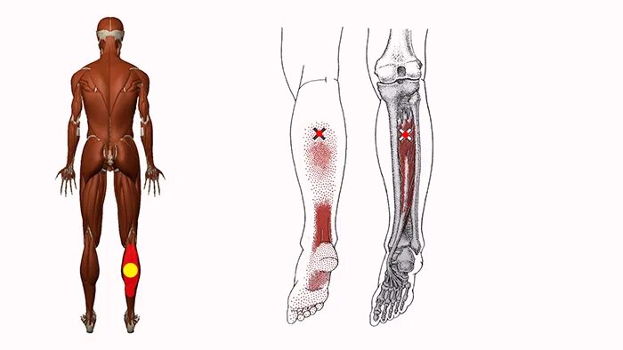 Триггерные точки нижних конечностей. Триггерные точки большеберцовой мышцы. Триггерные точки мышц голени. Триггерные точки икроножной мышцы.