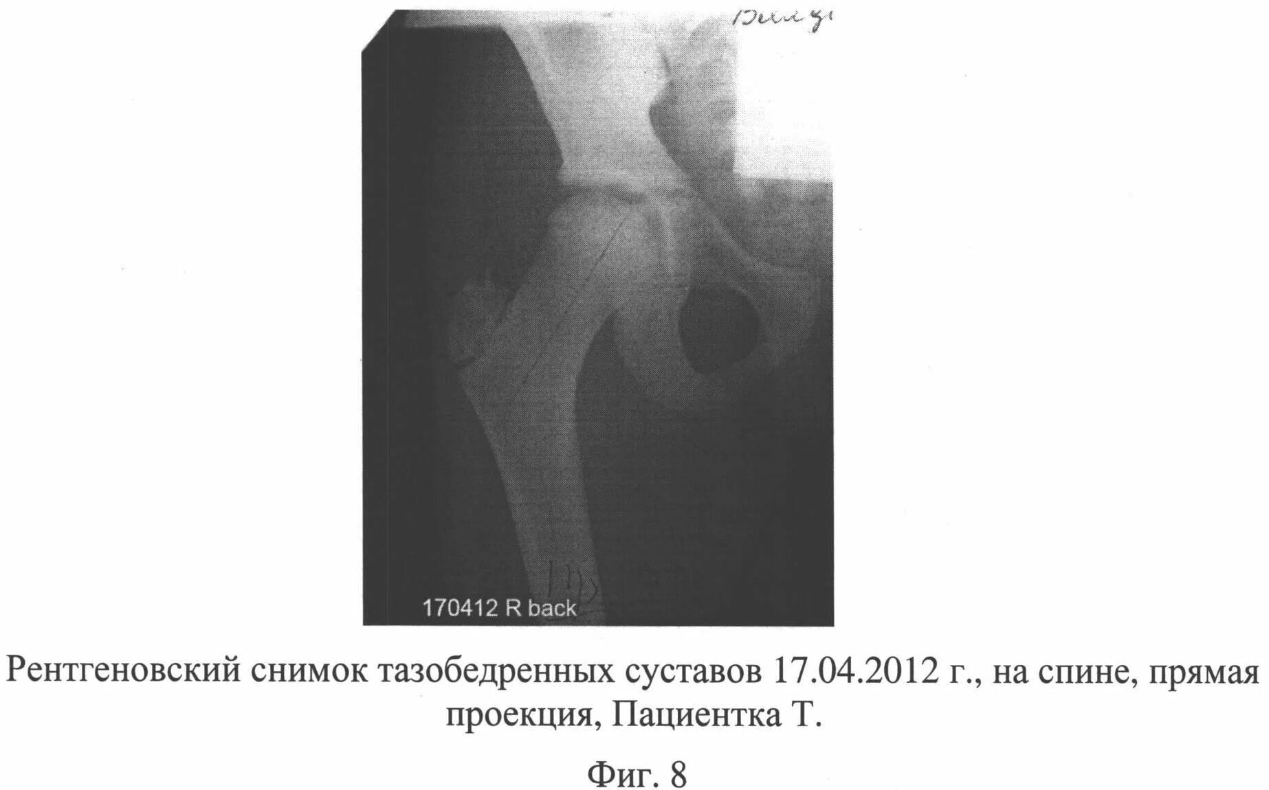 Асептический некроз бедренной кости кт. Асептический некроз тазобедренного сустава рентген. Асептический некроз головки тазобедренного сустава рентген. Некроз головки бедренной кости рентген. Асептический некроз головки мкб 10