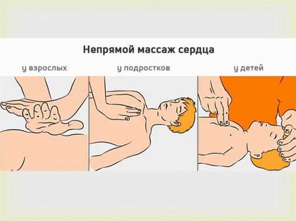 Как сделать непрямой массаж. Методика выполнения непрямого массажа сердца. как правильно проводить непрямой массаж сердца. непрямой массаж сердца техника выполнения у детей. массаж непрямой сердца у взрослого и у ребенка.