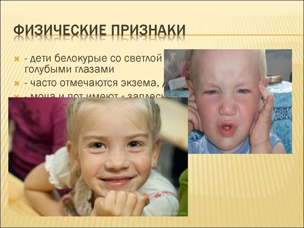 Концентрация детей. Синдром кошачьего крика мозаицизм. Диагноз ребенка малоконтактный ребенок. Симптомы дцп у грудничка в год. Дети с диагнозом альбатрос.