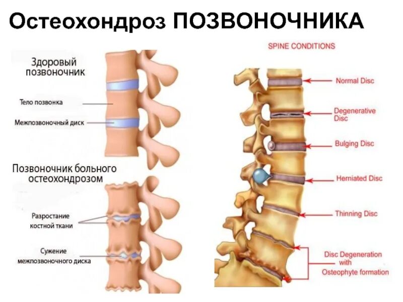 Что означает поясницы. Остеохондроз. Остеохондроз позвоночника. Позвоночник позвонки остеохондроз. Остеохондроз грудного отдела позвоночника.