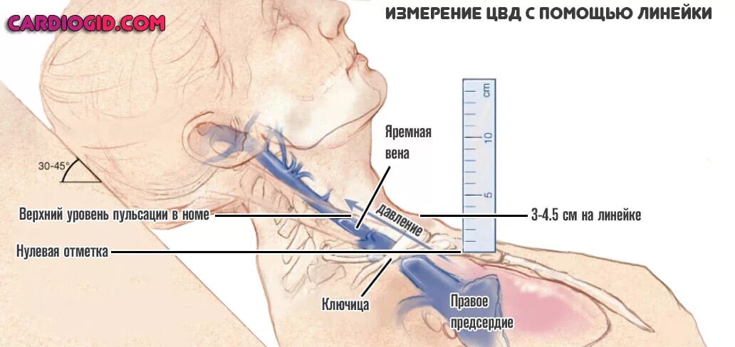 Техника измерения ЦВД линейкой. Измерение ЦВД алгоритм. Повышение центрального венозного давления в яремных венах.