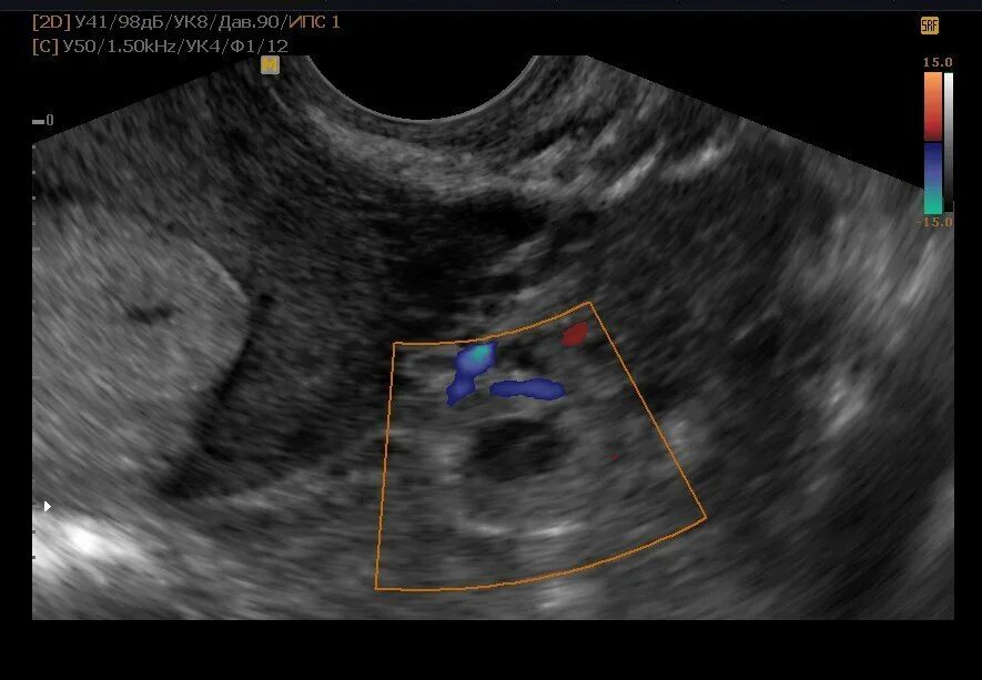Почему пульсирует матка. Внематочная яичниковая беременность на УЗИ. Внематочная беременность в трубе УЗИ. Внематочная Трубная беременность УЗИ. Шеечная внематочная беременность УЗИ.