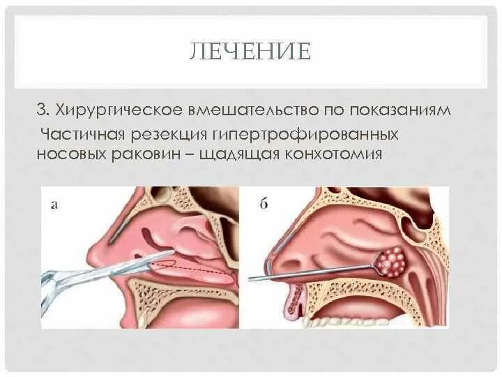 Лазер слизистой носа. Конхотомия нижних носовых раковин. Гипертрофия слизистой носовых раковин. Эндоскопическая подслизистая вазотомия нижних носовых раковин. Эндоскопическая резекция средней носовой раковины что это.