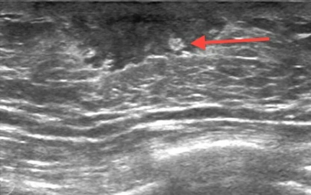 УЗИ молочных желёз гинекомастия. Ложная гинекомастия на УЗИ. Истинная гинекомастия протокол УЗИ. Юношеская гинекомастия на УЗИ.