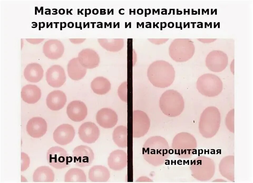 Макроциты понижены. Эритроциты нормальные величины. Макроциты понижены. Заболевания системы крови. Причина микроцитоза эритроцитов тест.