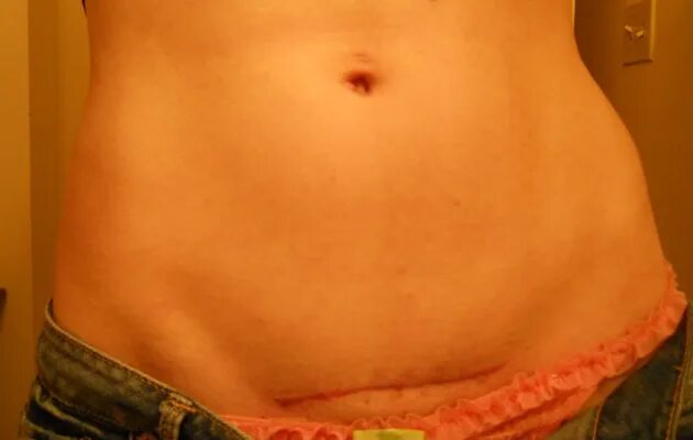 Кесарево сечение вертикальный разрез. Обезболивающее после кс. Обезболивающее после кс. Живот после кесарева сечения. Складка живота после кесарева сечения.