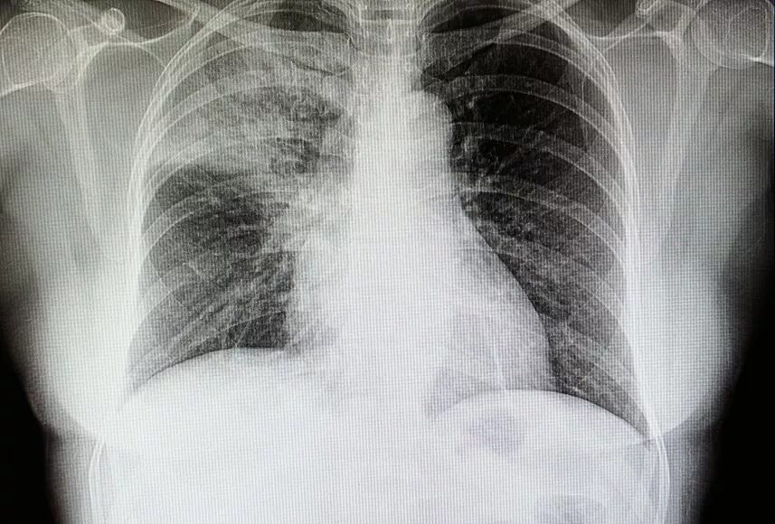 Поражение легких 3. Крупозная пневмония рентген. Пневмококковая пневмония рентген. Рентген грудной клетки туберкулез. Пневмония на рентгене.