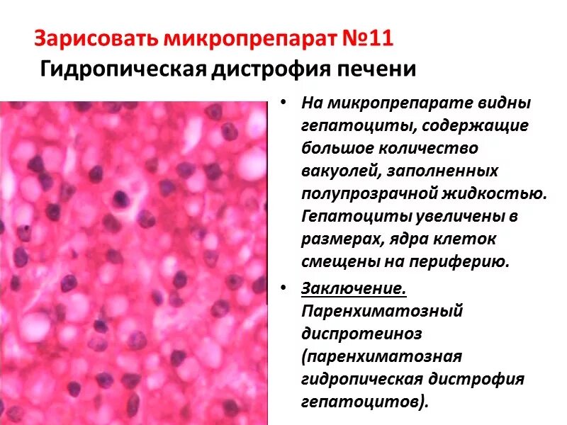 Признаки дистрофии печени. Гидропическая (баллонная дистрофия) печени. Белковая паренхиматозная дистрофия печени. Гидропическая дистрофия печени макропрепарат. Гидропическая дистрофия печени микропрепарат.