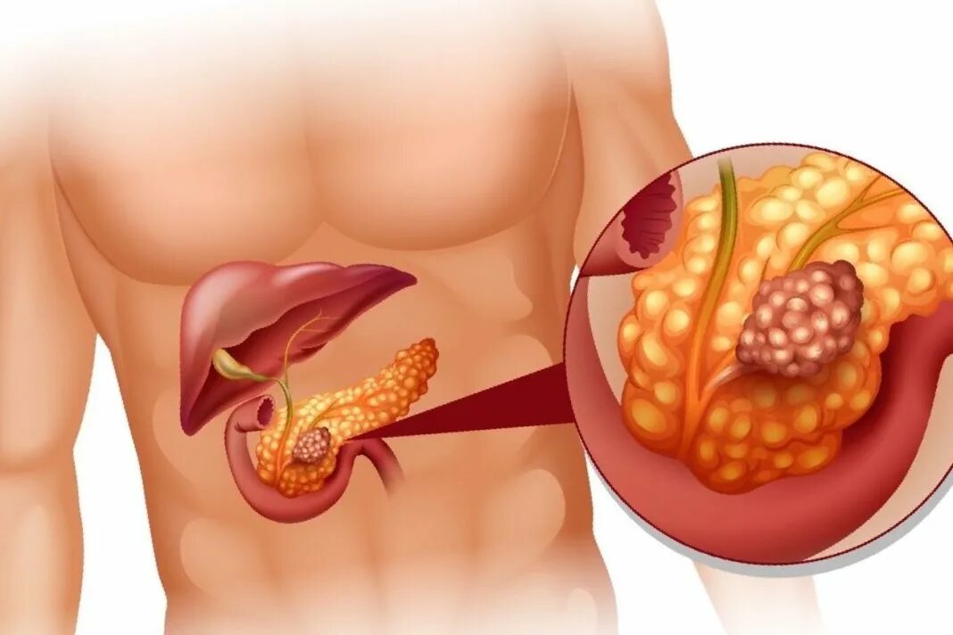 Панкреатит какой бок. Метастазы поджелудочной железы. Поджелужочная железа офто. Метастазы в поджелудочной железе.