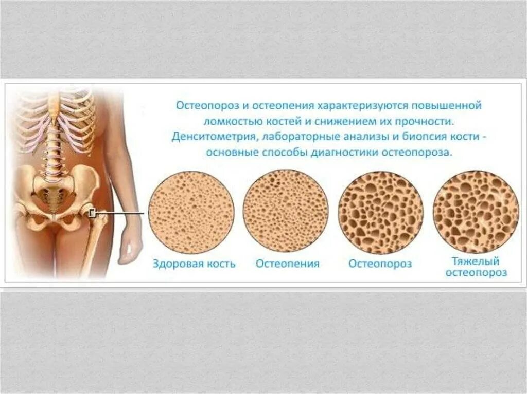 Остеопения и остеопороз. Болезнь костей остеопороз. Ломкость костей. Снижение прочности костей.