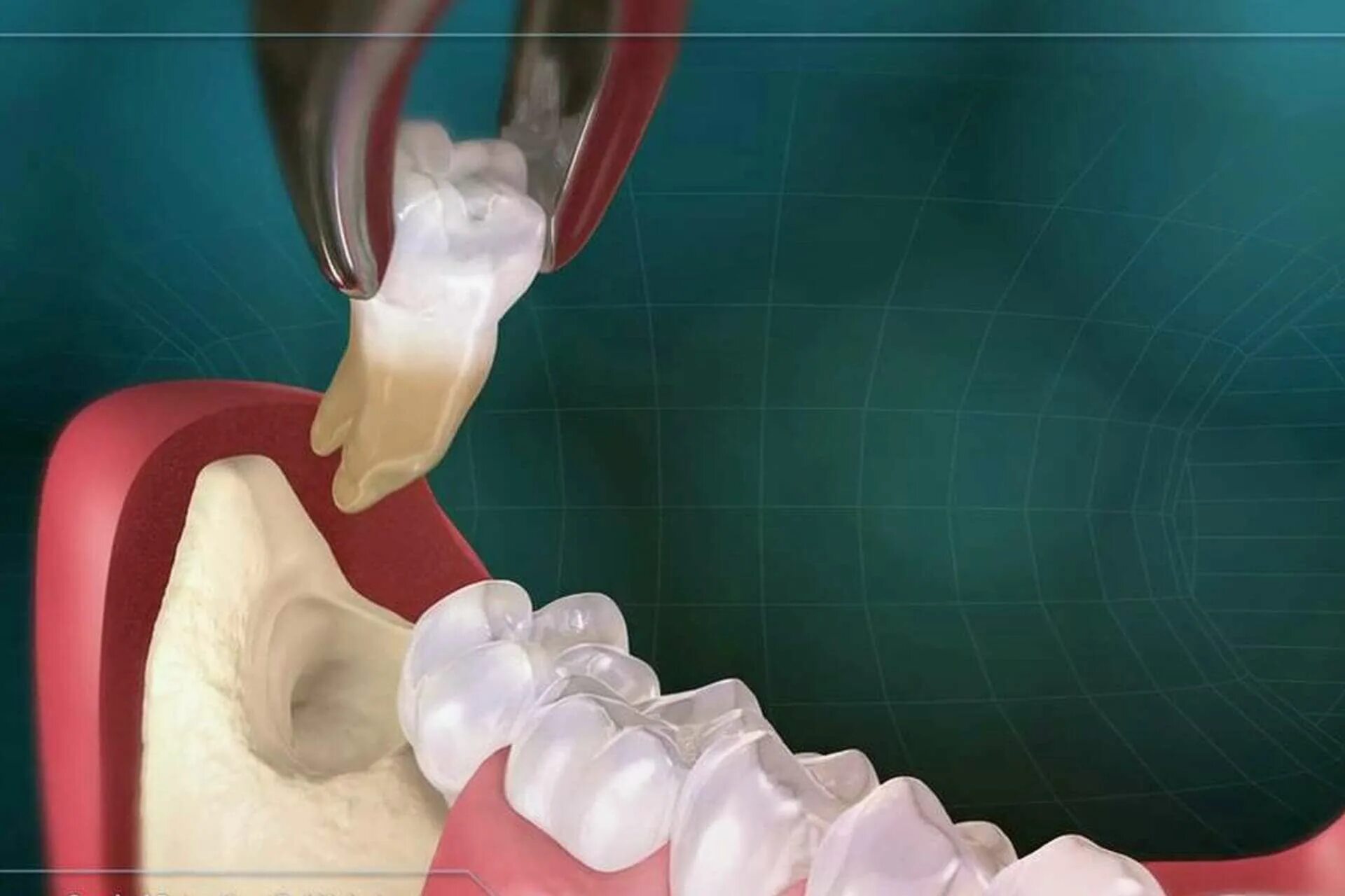 Лечат 8 зуб. Альвеолит стоматология. Альвеолит хирургическая стоматология. Альвеолит лунки мудрости.
